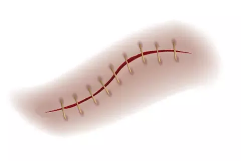 Снятие хирургических швов/скоб