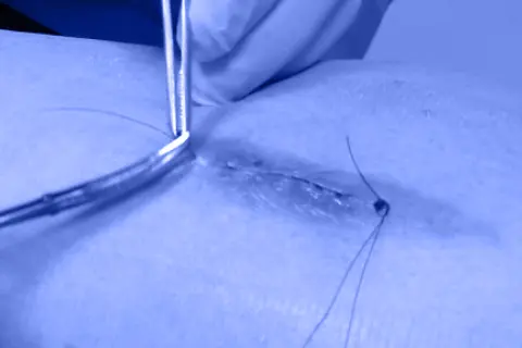 Скільки коштує зняття швів/скоб?