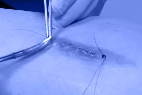 Скільки коштує зняття швів/скоб?